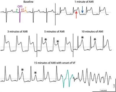 Frontiers Ventricular Arrhythmias In First Acute Myocardial